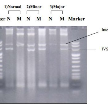 ژل ARMS-PCR برای تشخیص بتا-تالسمی