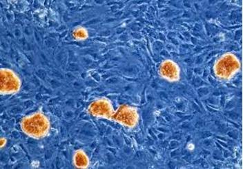 کشف روش جدید در مبارزه با سلول‌های بنیادی سرطانی
