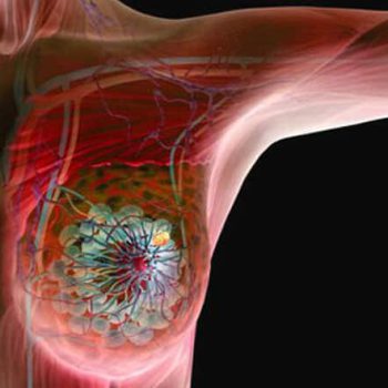 شناسایی راهکاری جدید برای گرسنه نگه داشتن و کشتن سلول های بنیادی سرطان سینه