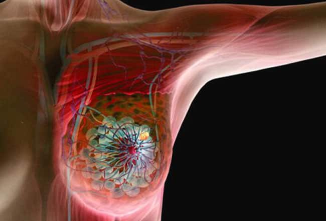 شناسایی راهکاری جدید برای گرسنه نگه داشتن و کشتن سلول های بنیادی سرطان سینه